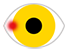 Icon: Pterygium